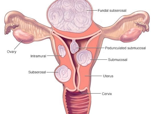 Miyomektomi nedir?